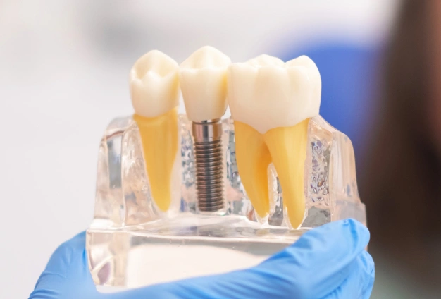 Artificial dental implants module