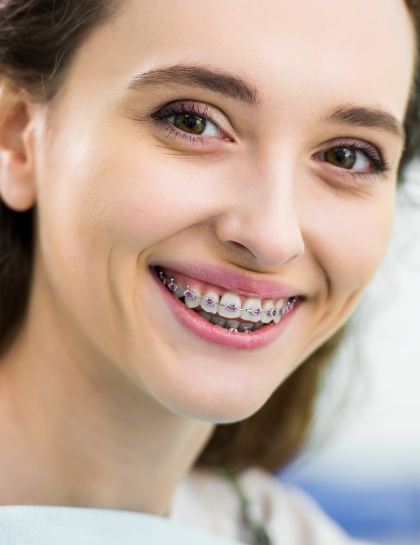 a beautiful women smiling after attached dental braces from orthodontist in Culver City